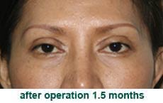 plastic-surgery-blepharoplasty